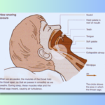 The Symphony of Snoring: Unveiling Causes and Prevention