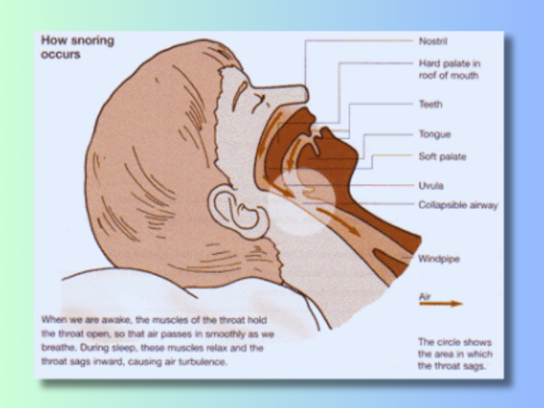 The Symphony of Snoring: Unveiling Causes and Prevention