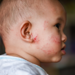 The Silent Agony: How Eczema is Triggered in Young Children and What Every Parent Must Know Now