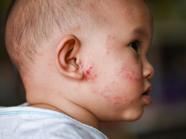 The Silent Agony: How Eczema is Triggered in Young Children and What Every Parent Must Know Now