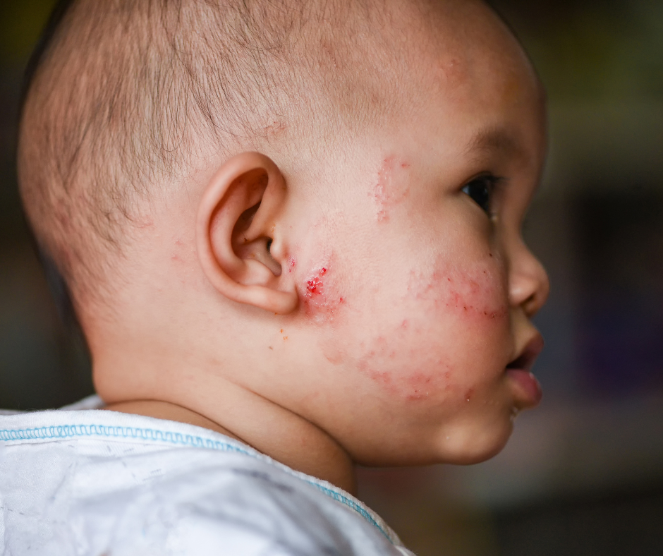 The Silent Agony: How Eczema is Triggered in Young Children and What Every Parent Must Know Now