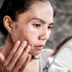 When Bacteria Breach the Skin’s Barrier: The Hidden War Beneath Your Skin