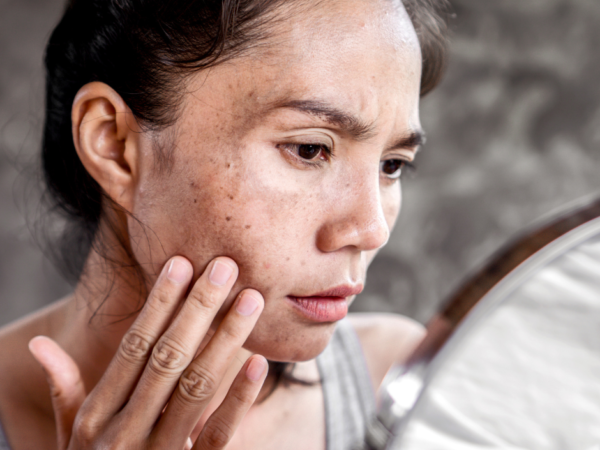 When Bacteria Breach the Skin’s Barrier: The Hidden War Beneath Your Skin