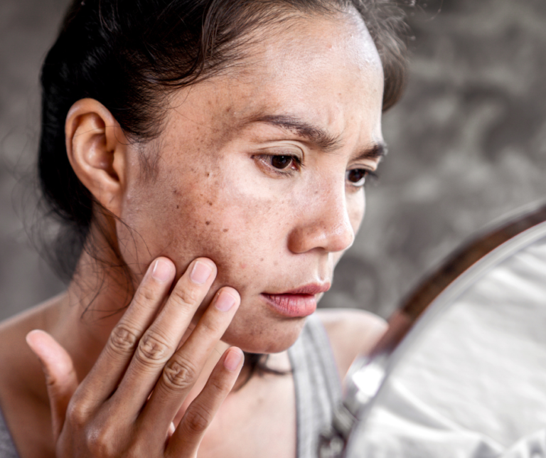 When Bacteria Breach the Skin’s Barrier: The Hidden War Beneath Your Skin